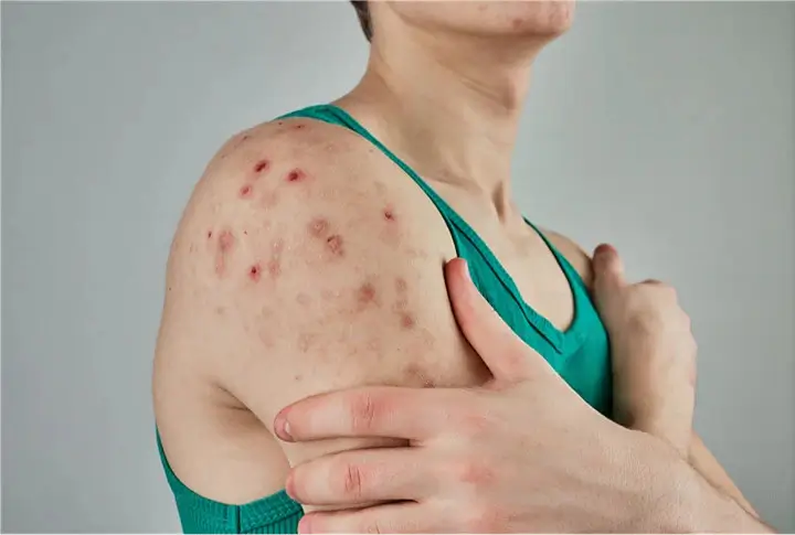 Antibacterial and antifungal properties of Alpha-Bisabolol for acne treatment