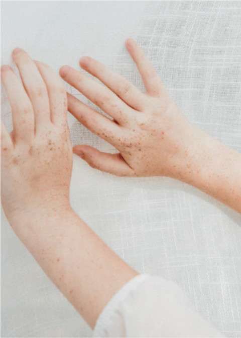 alpha-bisabolol benefits for acne-prone skin